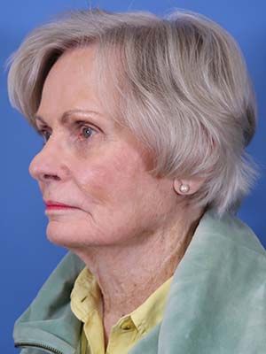 Reconstruction Before & After