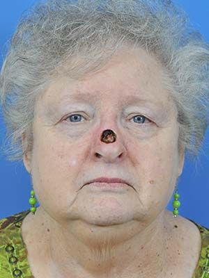 Reconstruction Before & After