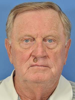 Reconstruction Before & After