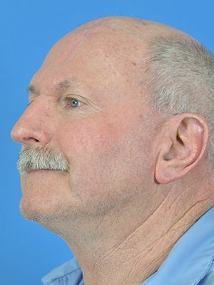 Reconstruction Before & After