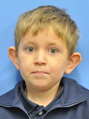 Otoplasty Before & After