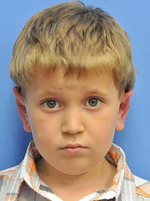 Otoplasty Before & After