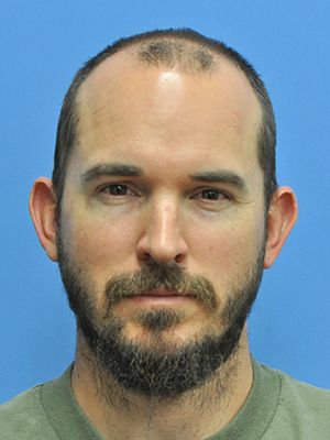 Otoplasty Before & After