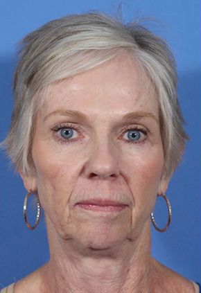 Liquid Facelift Before & After