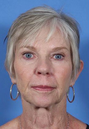 Liquid Facelift Before & After