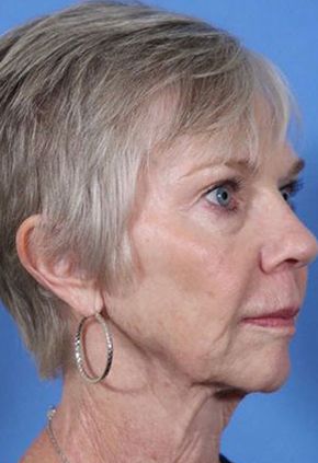 Liquid Facelift Before & After