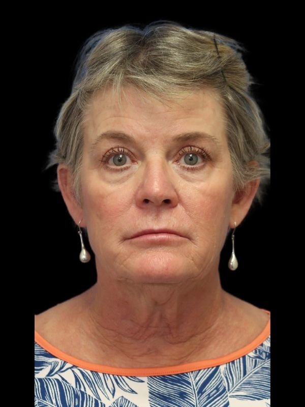 Blepharoplasty Before & After