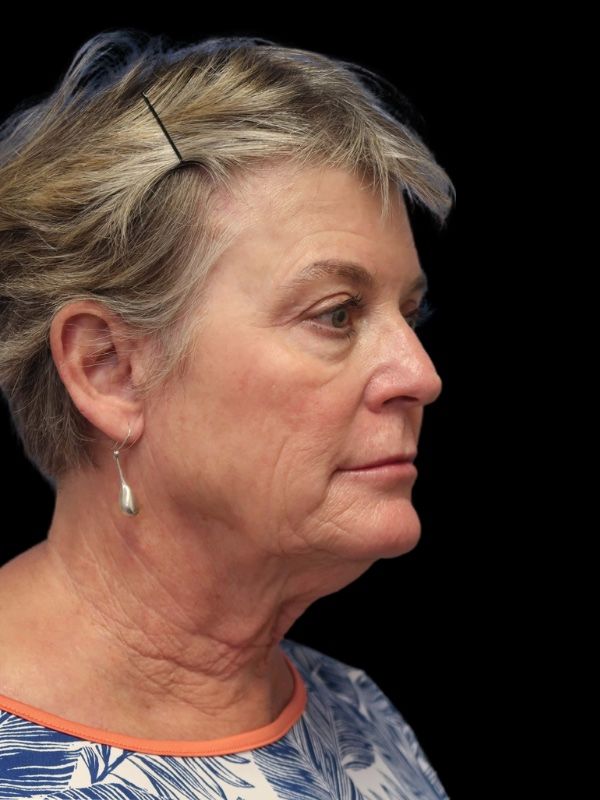 Blepharoplasty Before & After