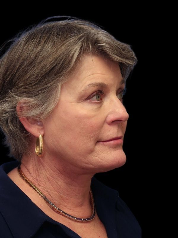 Blepharoplasty Before & After