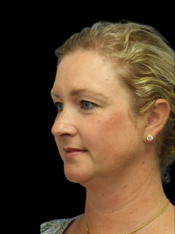 Blepharoplasty Before & After