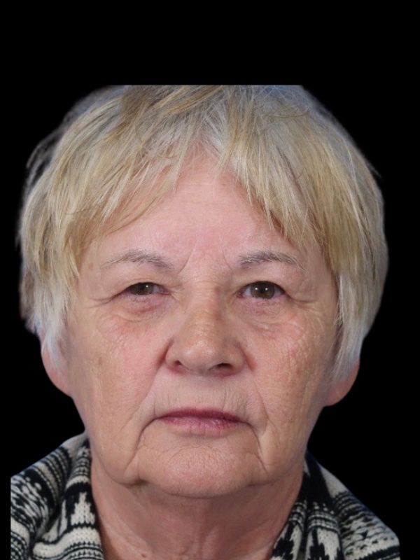 Blepharoplasty Before & After