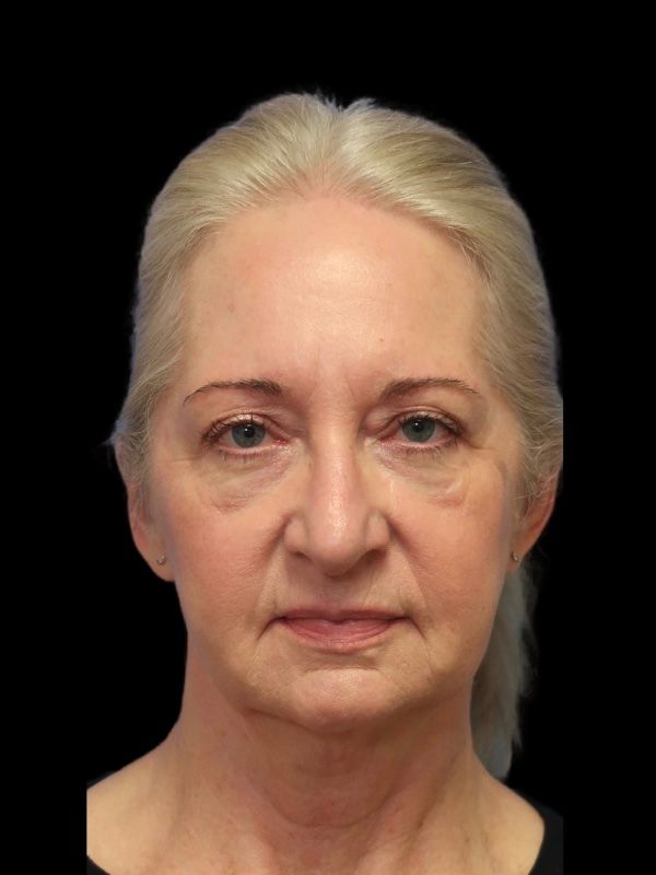Blepharoplasty Before & After
