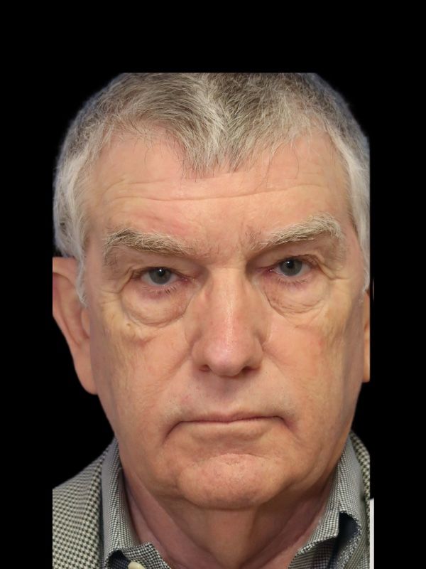 Blepharoplasty Before & After