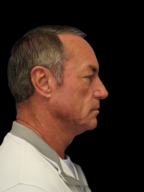 Blepharoplasty Before & After