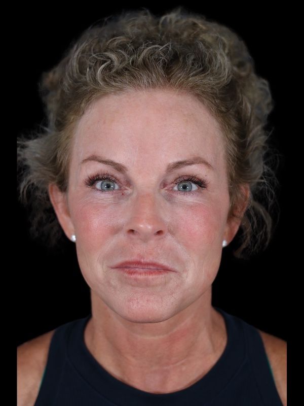 Blepharoplasty Before & After