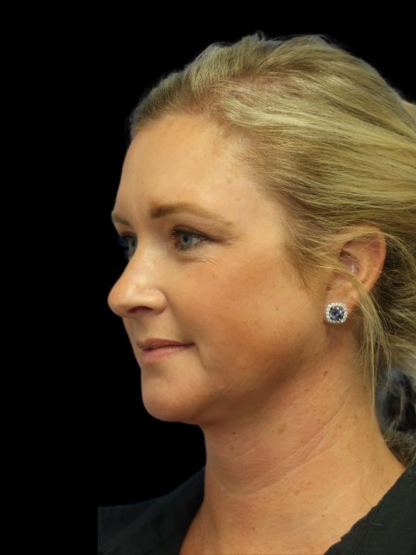 Blepharoplasty Before & After