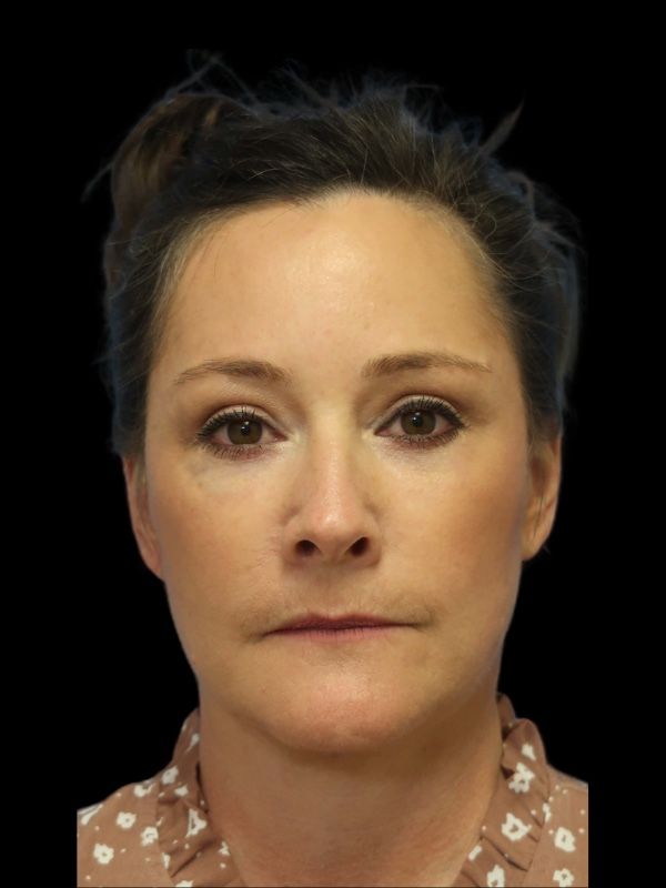 Blepharoplasty Before & After
