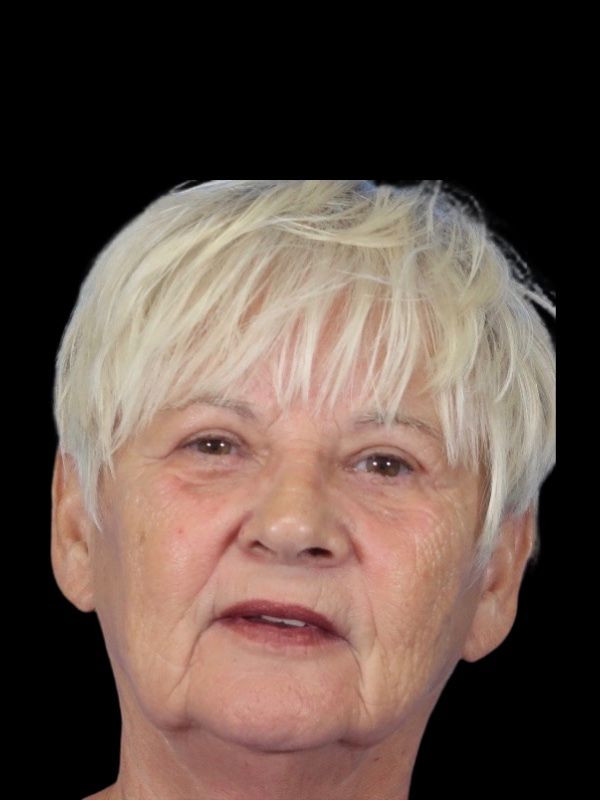 Blepharoplasty Before & After