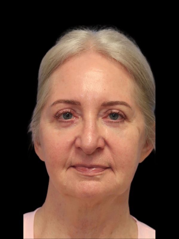 Blepharoplasty Before & After
