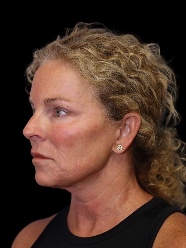 Blepharoplasty Before & After