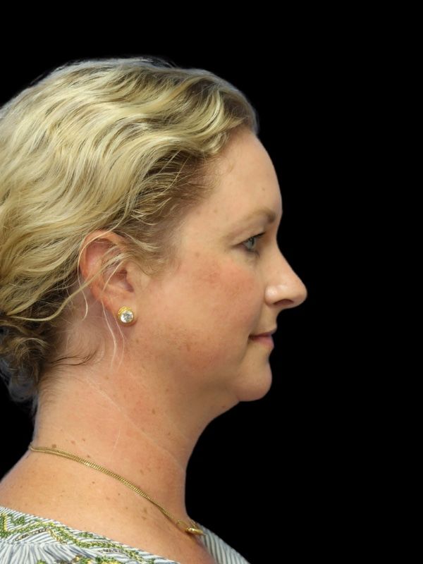 Blepharoplasty Before & After