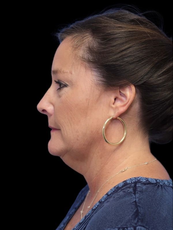 Blepharoplasty Before & After