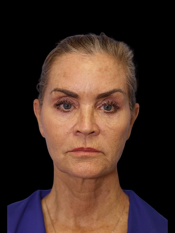 Blepharoplasty Before & After