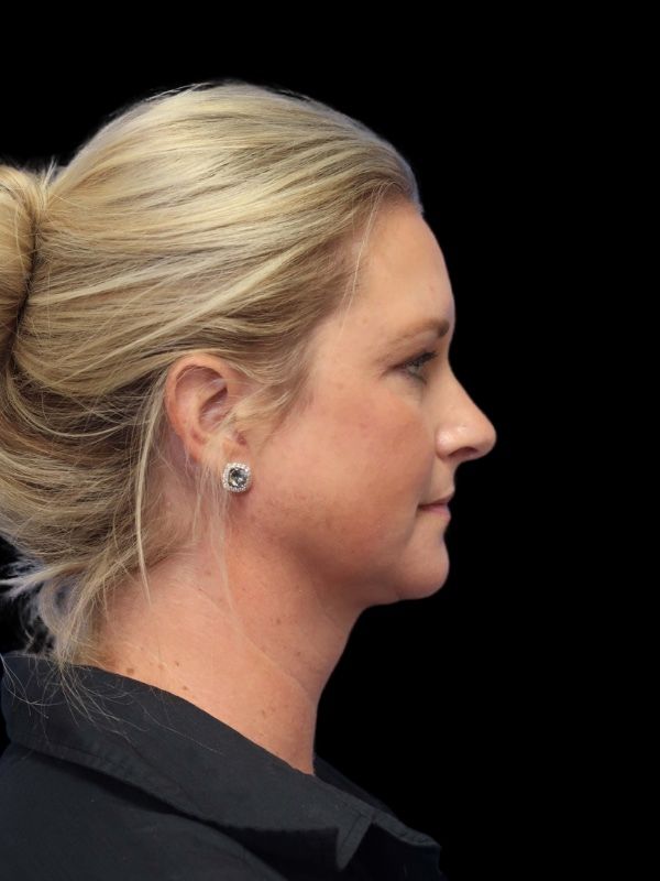 Blepharoplasty Before & After