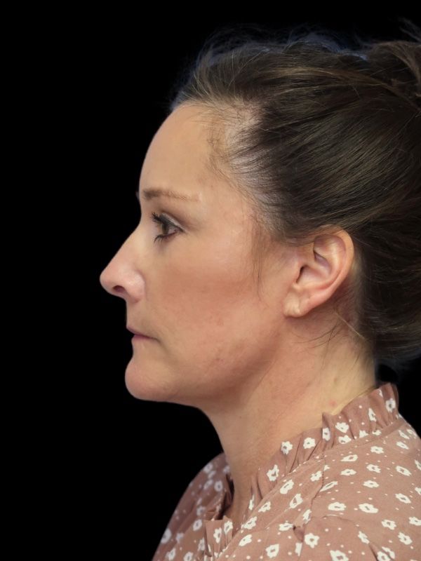 Blepharoplasty Before & After