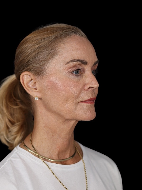 Blepharoplasty Before & After