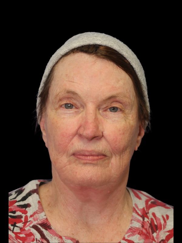 Blepharoplasty Before & After