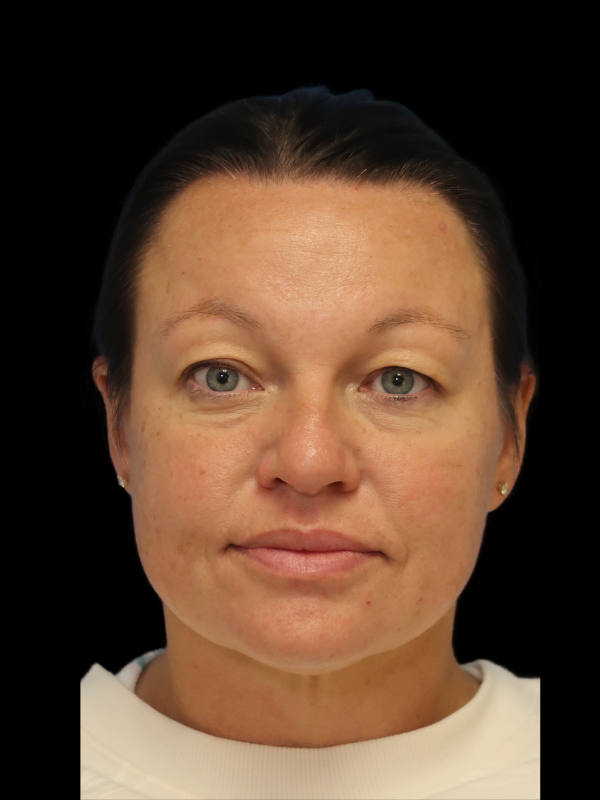 Blepharoplasty Before & After