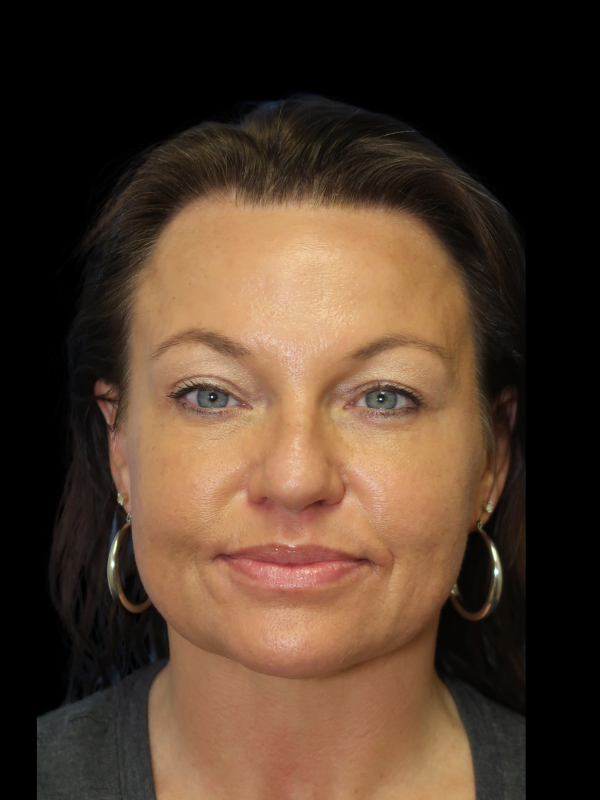 Blepharoplasty Before & After