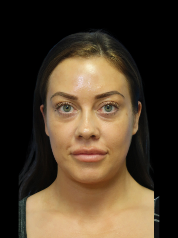 Blepharoplasty Before & After
