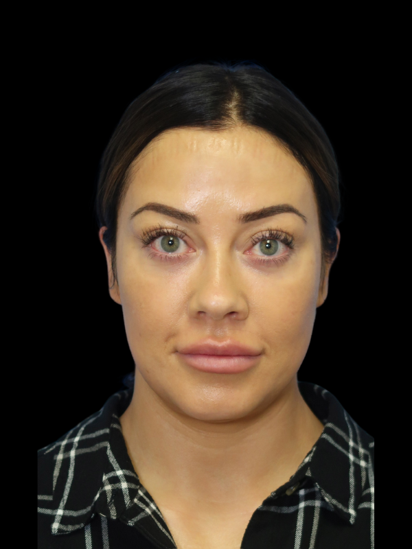 Blepharoplasty Before & After