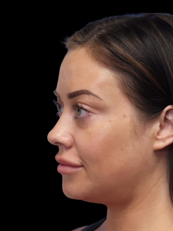 Blepharoplasty Before & After