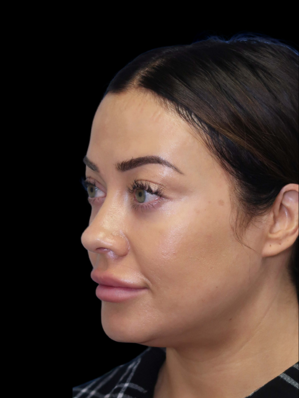 Blepharoplasty Before & After