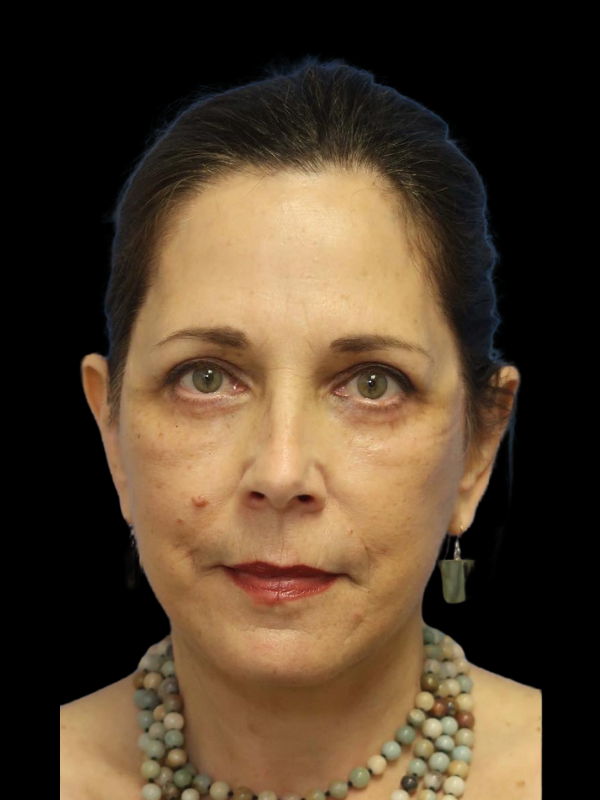 Blepharoplasty Before & After