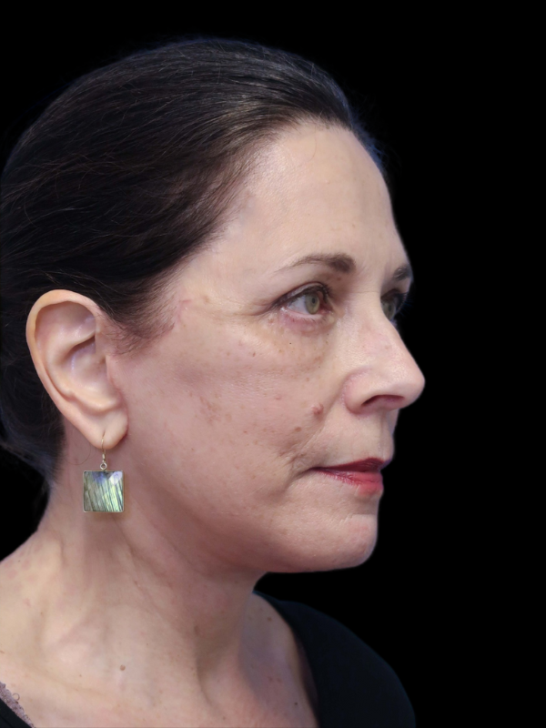 Blepharoplasty Before & After