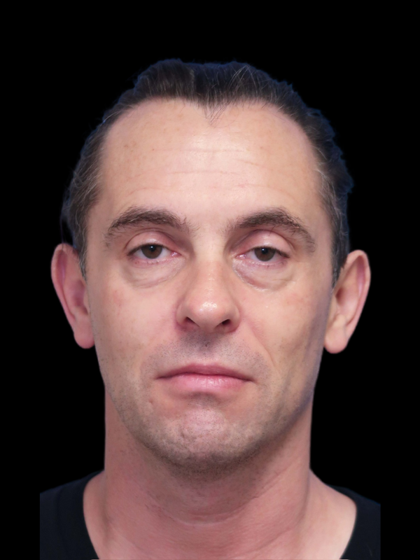 Blepharoplasty Before & After