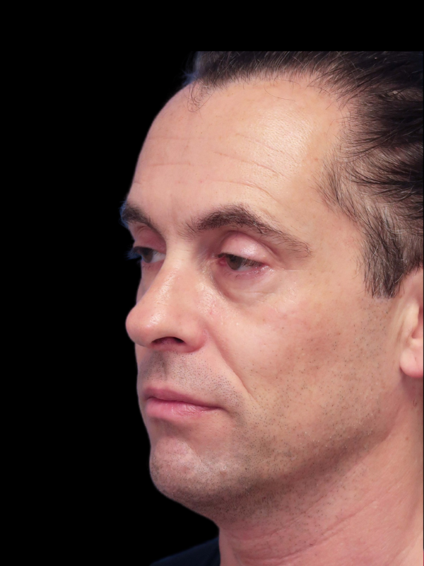 Blepharoplasty Before & After