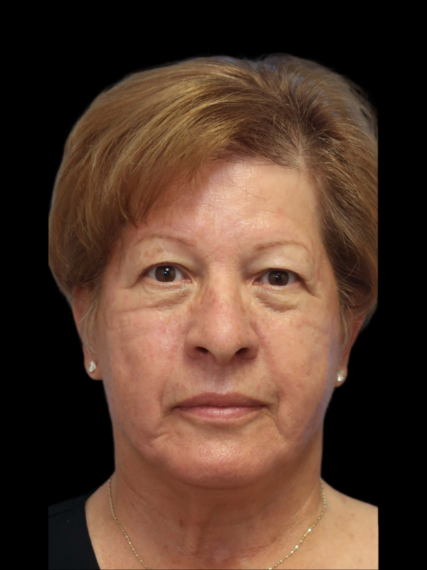 Blepharoplasty Before & After