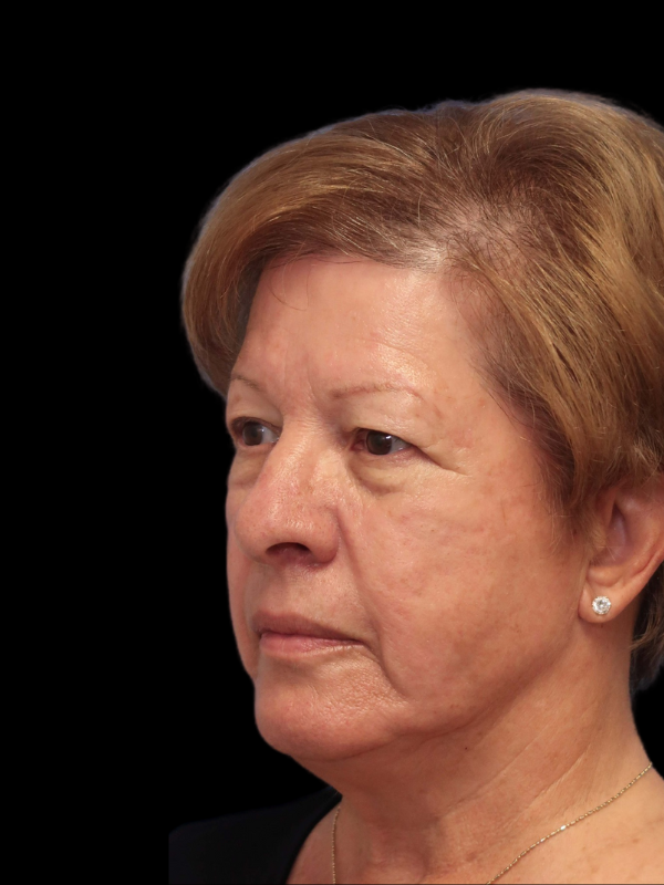 Blepharoplasty Before & After