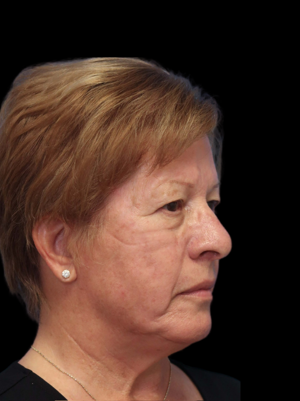 Blepharoplasty Before & After