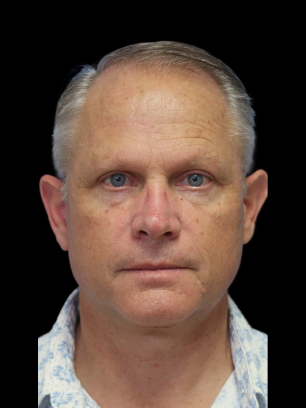 Blepharoplasty Before & After