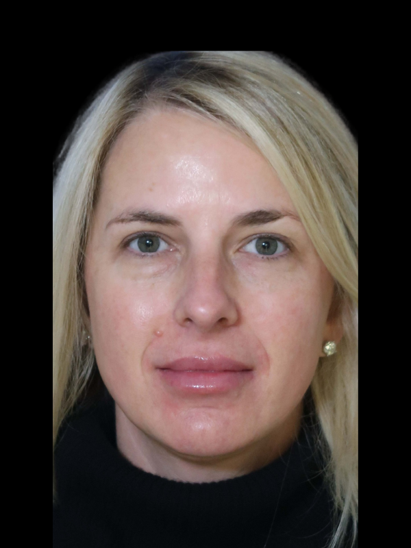 Blepharoplasty Before & After