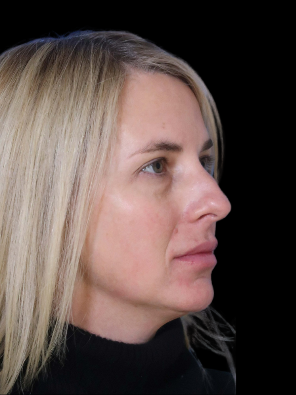 Blepharoplasty Before & After