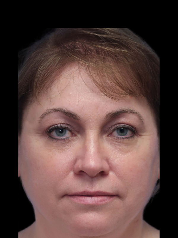 Blepharoplasty Before & After