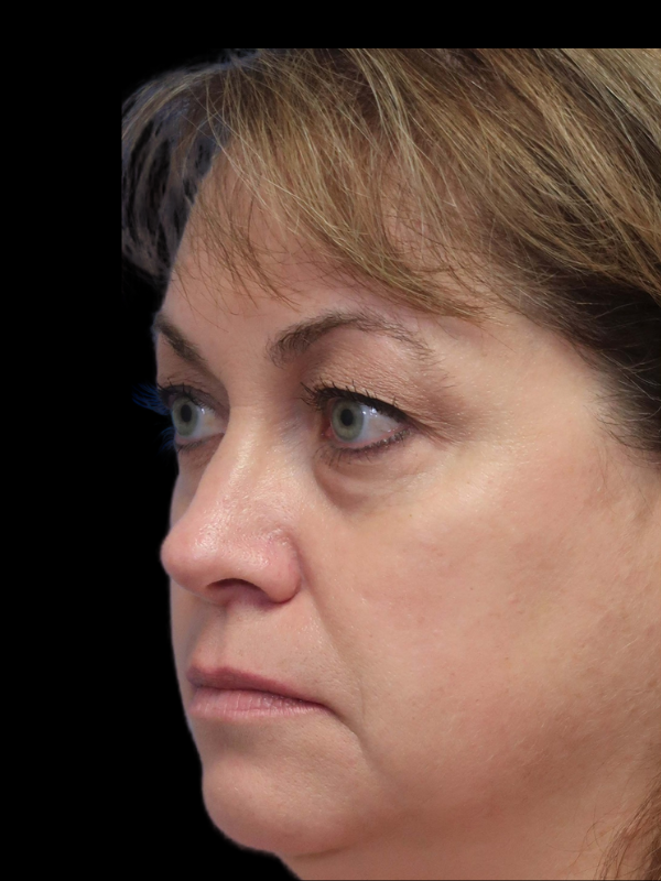 Blepharoplasty Before & After