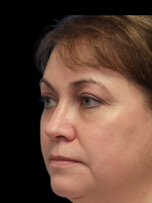 Blepharoplasty Before & After